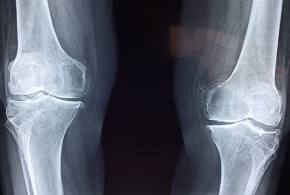 Joint Replacement